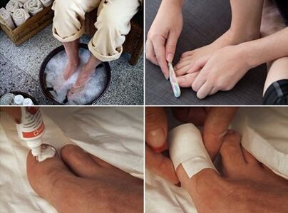 A lábak párolása és karbamidkrém felvitele a gomba által érintett körmökre
