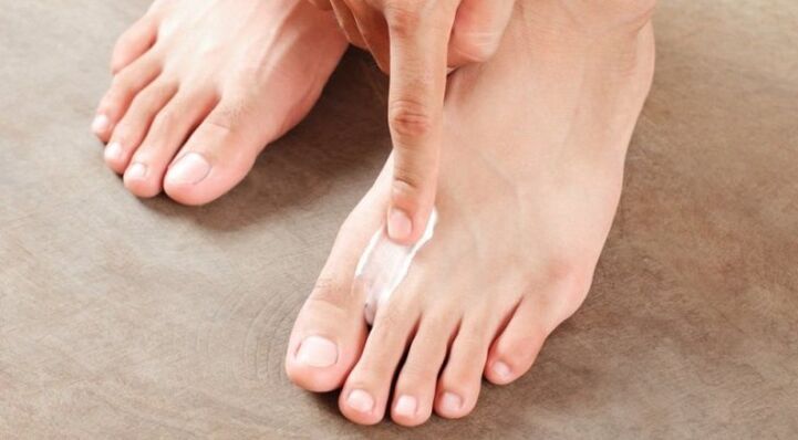 hogyan és hogyan kell kezelni a lábujjak közötti gombát