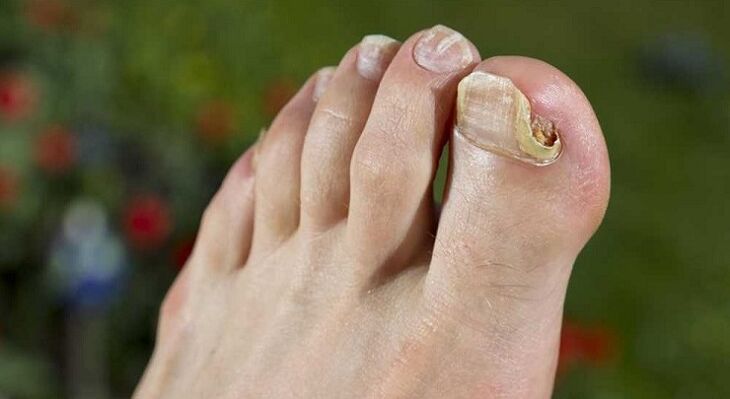 a körömlemez károsodása gombával a lábakon