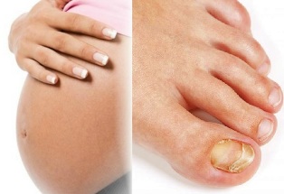 lábgombásodás terhesség
