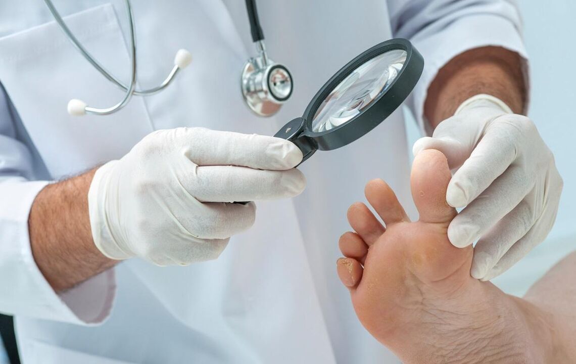 orvos megvizsgálja a lábát gombával
