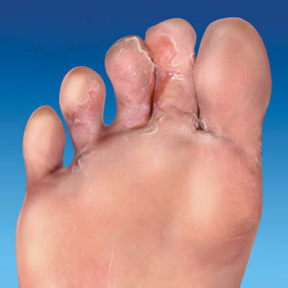 a bőr gombás láb