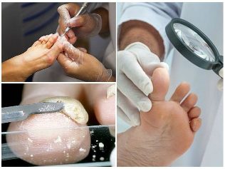 gomba láb bőrét diagnózis
